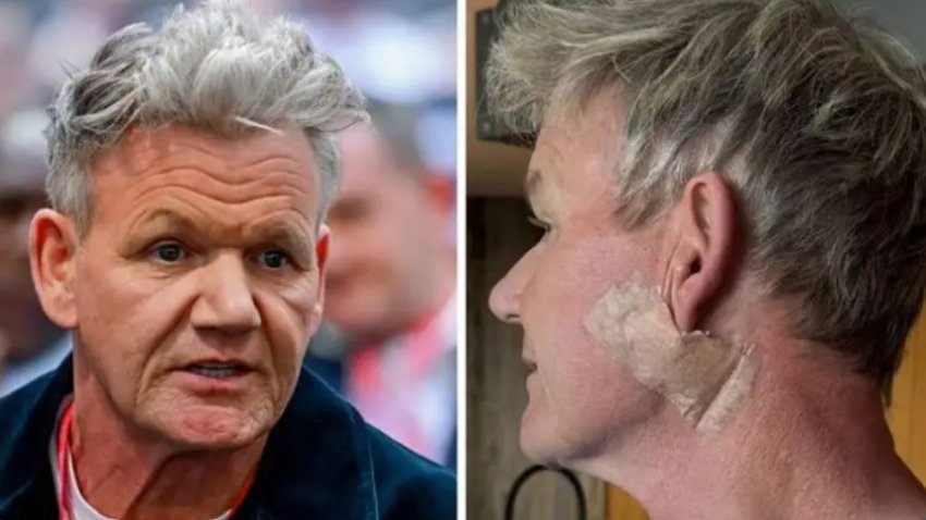 Gordon Ramsay kalon nëpër një operacion për kancerin e lëkurës: Mesazhi i tij për fansat 1 gordon ramsay kalon neper nje operacion per kancerin e lekures mesazhi i tij per fansat 68b2ebf76d412