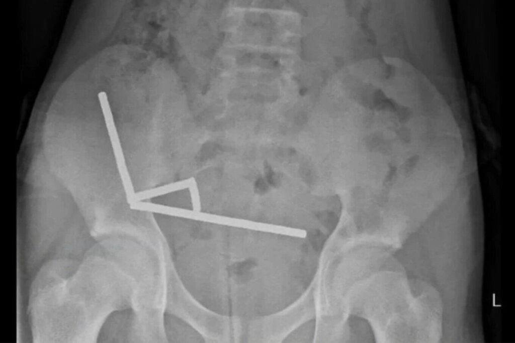 mjeket ne zelanden e re heqin dhjetera magnete nga zorret e nje 13 vjecari 68fbd8a597108