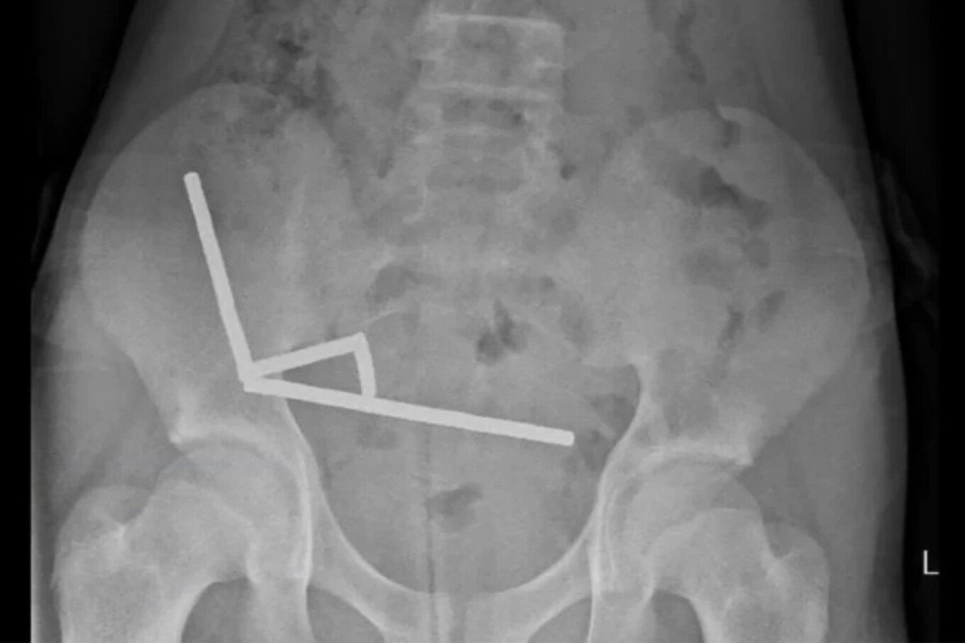 mjeket ne zelanden e re heqin dhjetera magnete nga zorret e nje 13 vjecari 68fbd8a597108