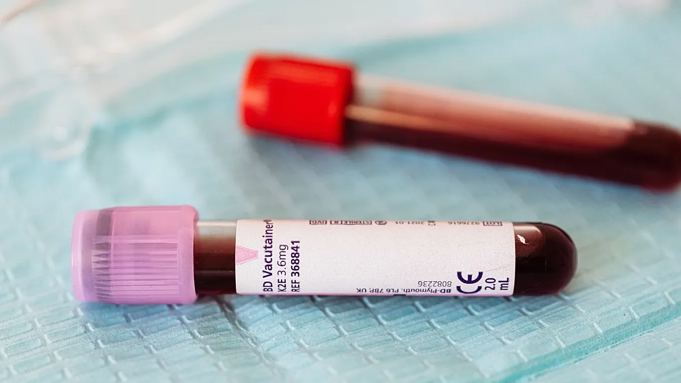 etiopia konfirmon vdekjen e 3 personave nga virusi marburg alarm rajonal 691b7af82be8a