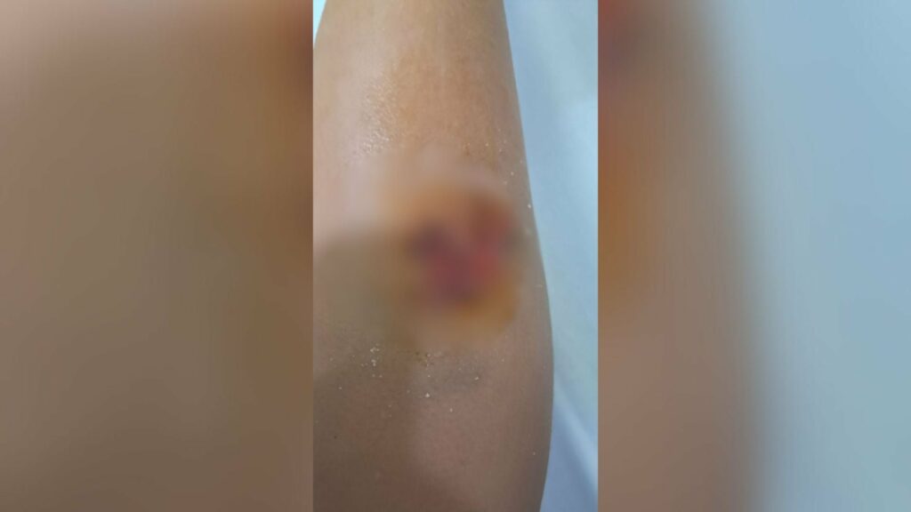 e rende 8 vjecari sulmohet nga nje qen endacak ne durres 69494aa59ac13