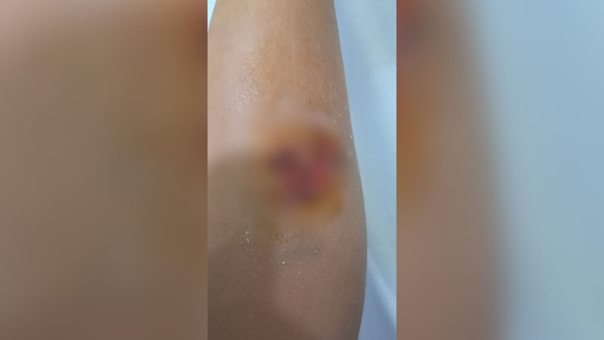 e rende 8 vjecari sulmohet nga nje qen endacak ne durres 69494aa59ac13